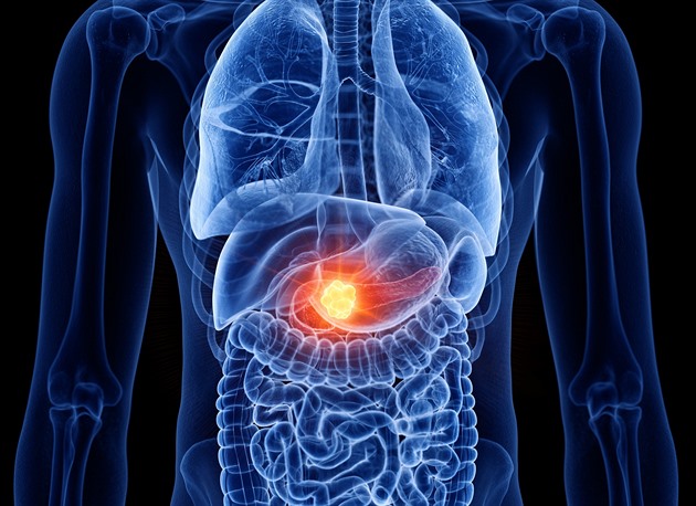 AI přispěje k detekci rakoviny slinivky. V Pardubicích vyvíjí unikátní software