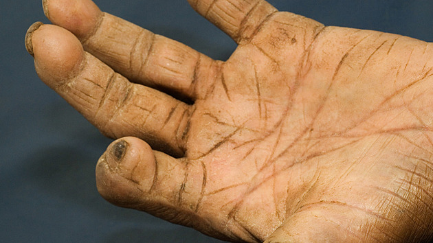 V Rumunsku se po 40 letech objevila lepra, nakažené pracovaly jako masérky